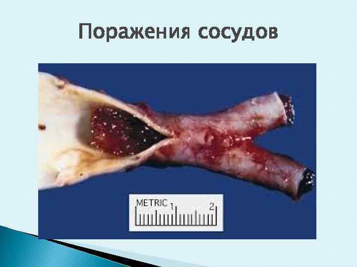 Поражения сосудов 