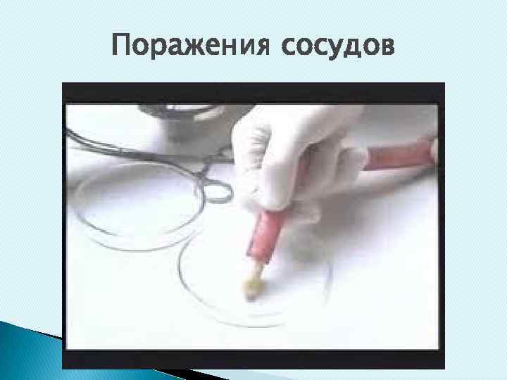 Поражения сосудов 