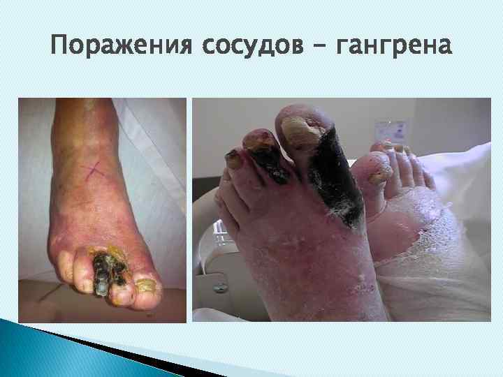 Поражения сосудов - гангрена 