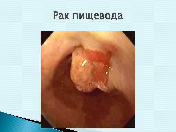 Рак пищевода 