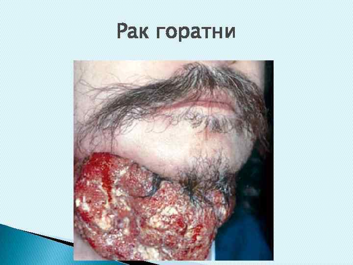 Рак горатни 