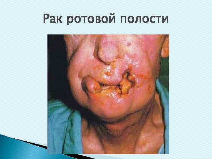 Рак ротовой полости 