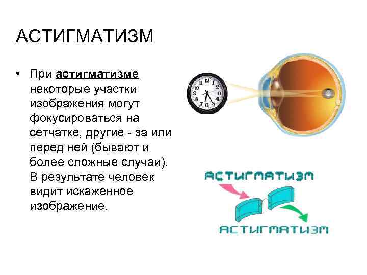 АСТИГМАТИЗМ • При астигматизме некоторые участки изображения могут фокусироваться на сетчатке, другие за или