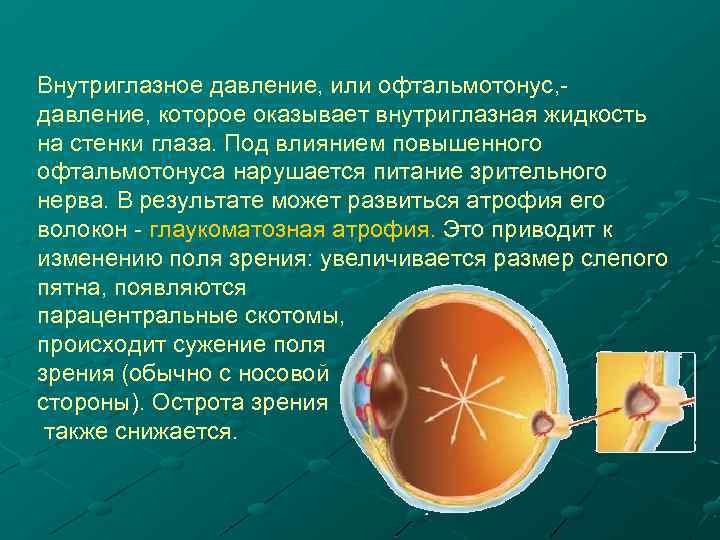 Внутриглазное давление, или офтальмотонус, давление, которое оказывает внутриглазная жидкость на стенки глаза. Под влиянием