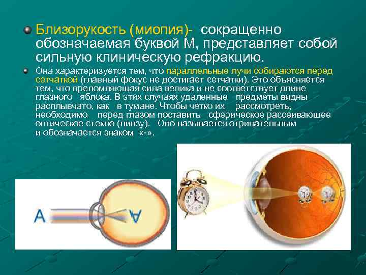 Какая степень миопии высокая. Степени близорукости. Степени миопии. Стадии близорукости. Миопия 1.