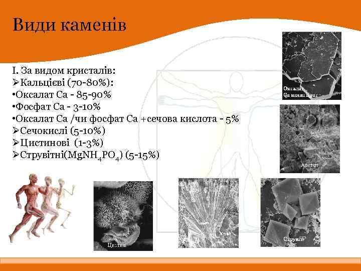 Види каменів І. За видом кристалів: ØКальцієві (70 -80%): • Оксалат Са - 85