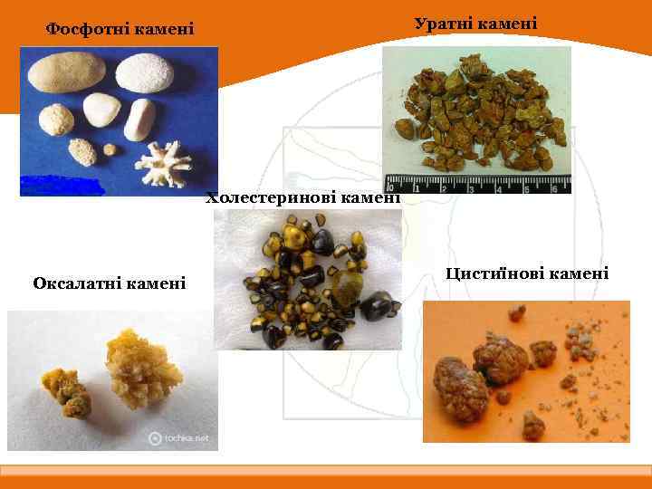 Уратні камені Фосфотні камені Холестеринові камені Оксалатні камені Цистиїнові камені 
