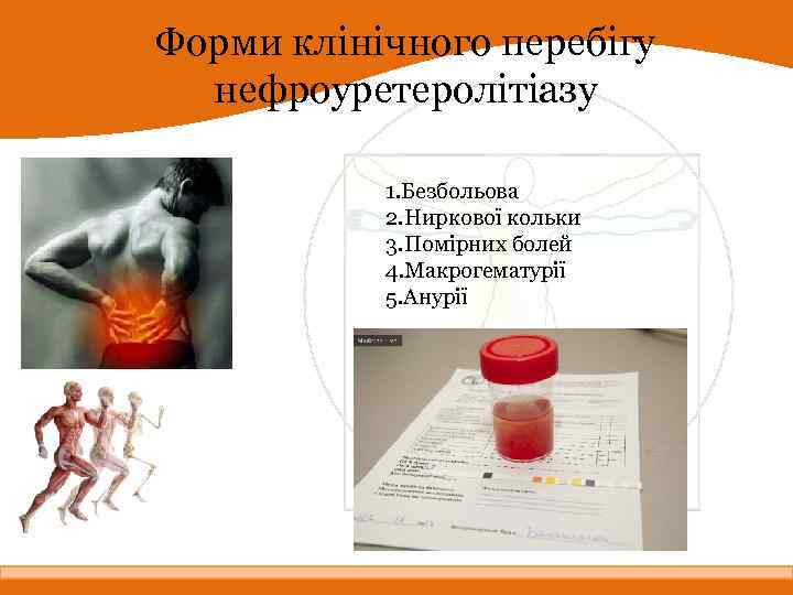 Форми клінічного перебігу нефроуретеролітіазу 1. Безбольова 2. Ниркової кольки 3. Помірних болей 4. Макрогематурії