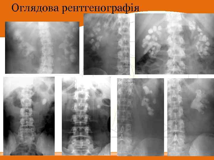 Оглядова рентгенографія 