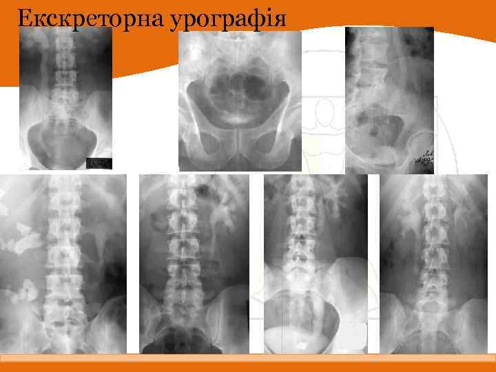 Екскреторна урографія 