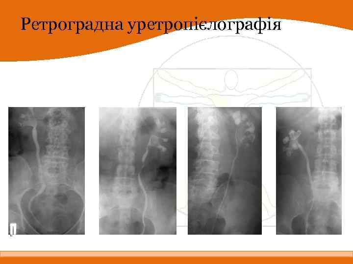 Ретроградна уретропієлографія 
