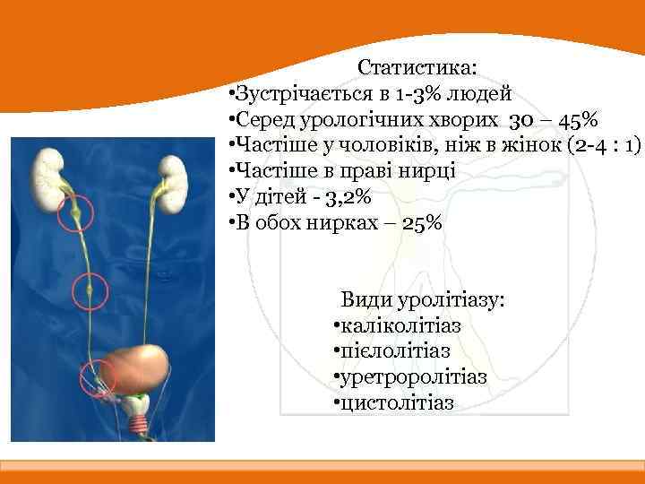 Статистика: • Зустрічається в 1 -3% людей • Серед урологічних хворих 30 – 45%