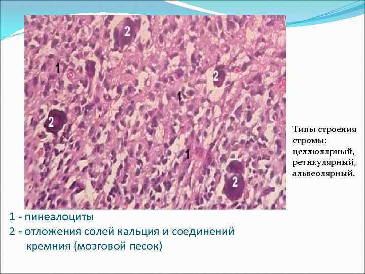 Типы строения стромы: целлюллрный, ретикулярный, альвеолярный. 1 - пинеалоциты 2 - отложения солей кальция