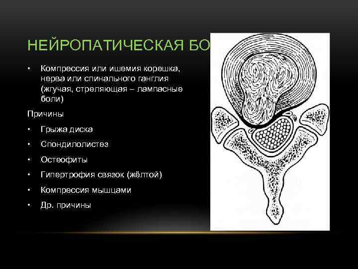 НЕЙРОПАТИЧЕСКАЯ БОЛЬ • Компрессия или ишемия корешка, нерва или спинального ганглия (жгучая, стреляющая –