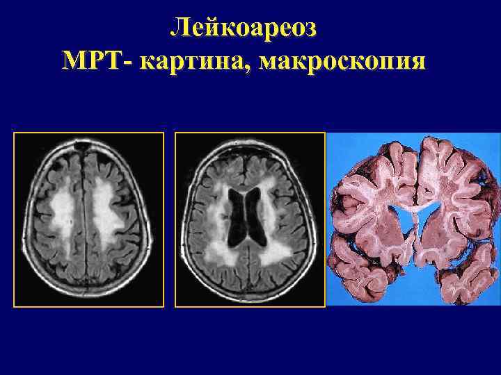 Лейкоареоз МРТ- картина, макроскопия 