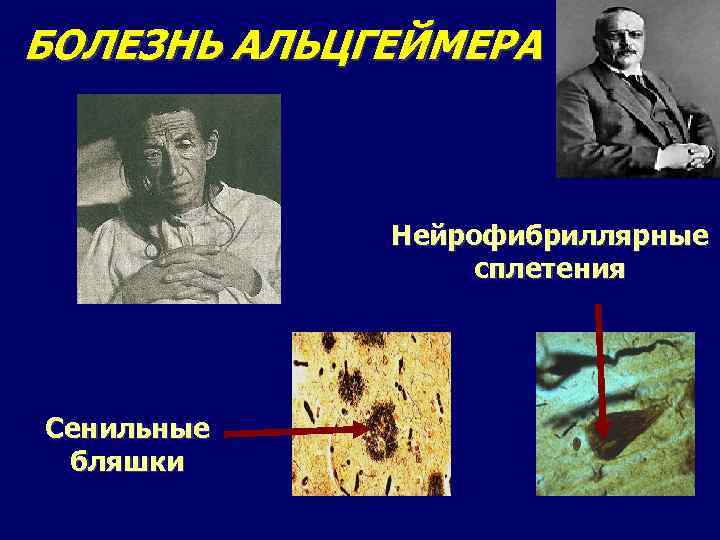 БОЛЕЗНЬ АЛЬЦГЕЙМЕРА Нейрофибриллярные сплетения Сенильные бляшки 