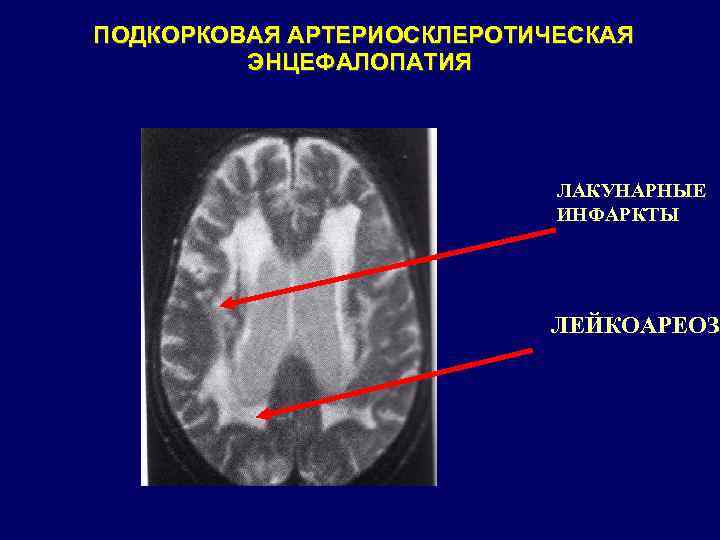ПОДКОРКОВАЯ АРТЕРИОСКЛЕРОТИЧЕСКАЯ ЭНЦЕФАЛОПАТИЯ ЛАКУНАРНЫЕ ИНФАРКТЫ ЛЕЙКОАРЕОЗ 