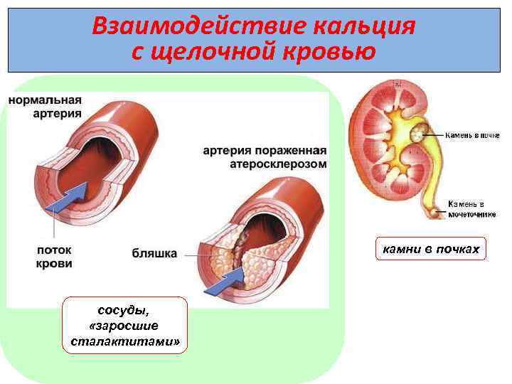 Взаимодействие кальция с щелочной кровью камни в почках сосуды, «заросшие сталактитами» 