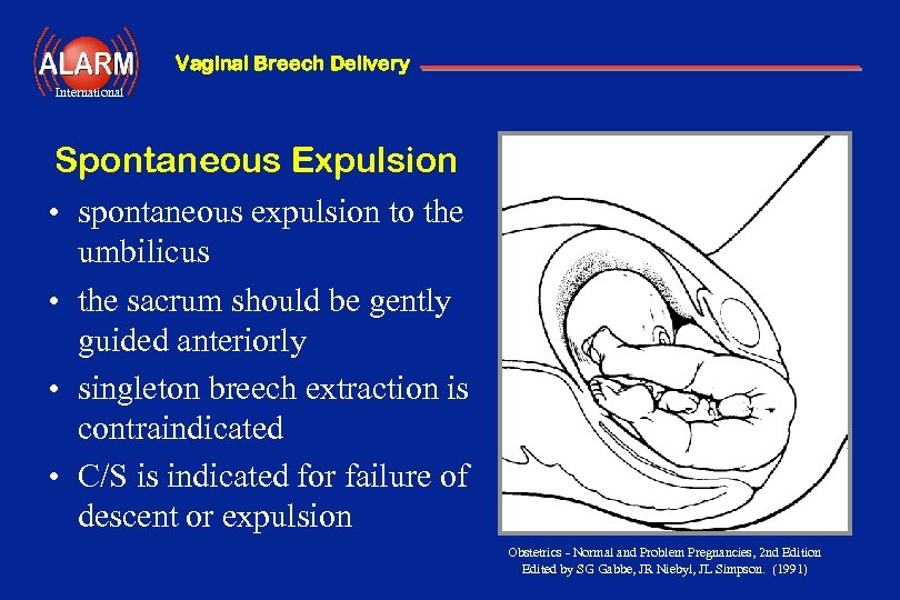 Vaginal Breech Delivery International Vaginal Breech Delivery