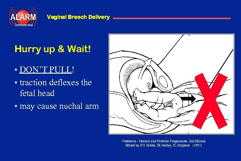 Vaginal Breech Delivery International Hurry up & Wait! • DON’T PULL! • traction deflexes