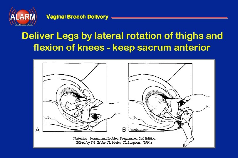 Vaginal Breech Delivery International Deliver Legs by lateral rotation of thighs and flexion of