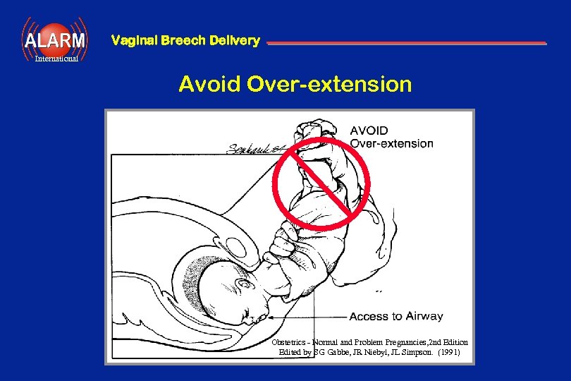 Vaginal Breech Delivery International Avoid Over-extension Obstetrics - Normal and Problem Pregnancies, 2 nd