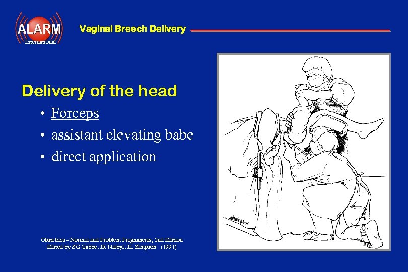 Vaginal Breech Delivery International Delivery of the head • Forceps • assistant elevating babe