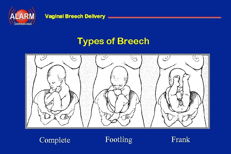 Vaginal Breech Delivery International Types of Breech Complete Footling Frank 