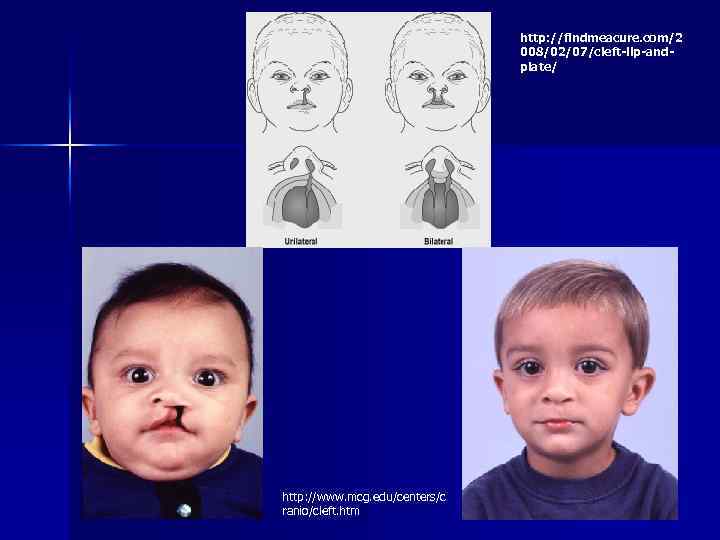 http: //findmeacure. com/2 008/02/07/cleft-lip-andplate/ http: //www. mcg. edu/centers/c ranio/cleft. htm 