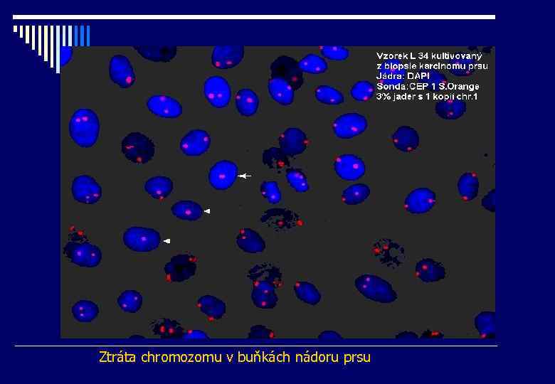 Ztráta chromozomu v buňkách nádoru prsu 