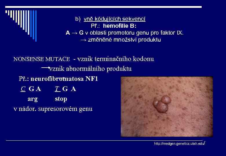 b) vně kódujících sekvencí Př. : hemofilie B: A → G v oblasti promotoru