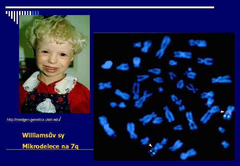 http: //medgen. genetics. utah. edu/ Williamsův sy Mikrodelece na 7 q 