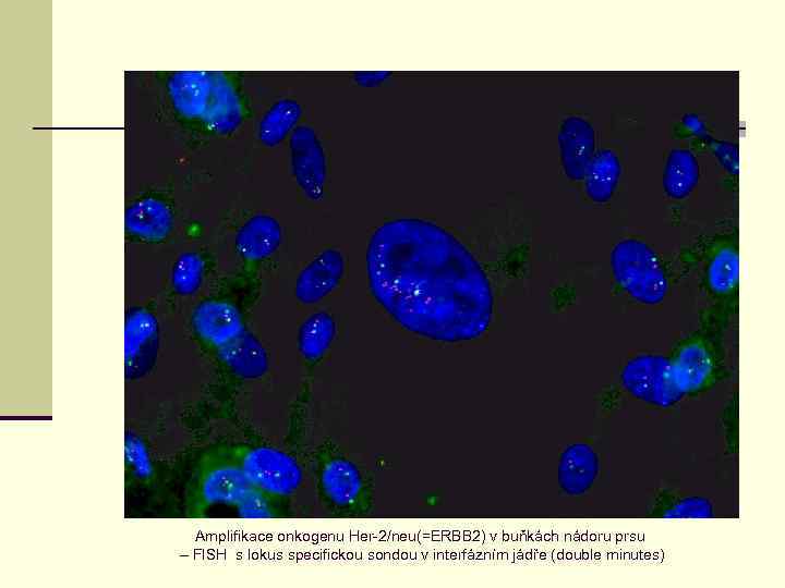 Amplifikace onkogenu Her-2/neu(=ERBB 2) v buňkách nádoru prsu – FISH s lokus specifickou sondou