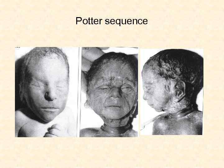 Potter sequence 