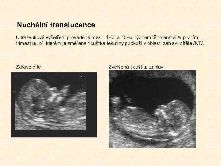 Nuchální translucence Ultrazvukové vyšetření provedené mezi 11+0 a 13+6 týdnem těhotenství /v prvním trimestru/,
