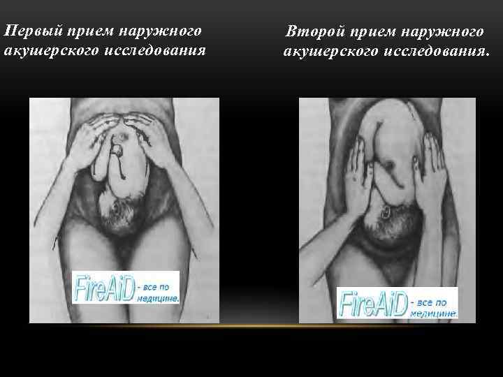 Первый прием наружного акушерского исследования Второй прием наружного акушерского исследования. 