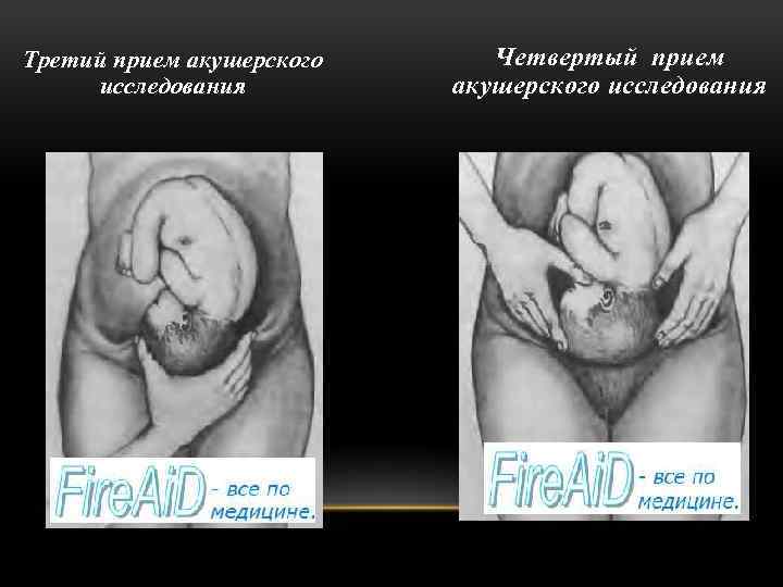 Третий прием акушерского исследования Четвертый прием акушерского исследования 