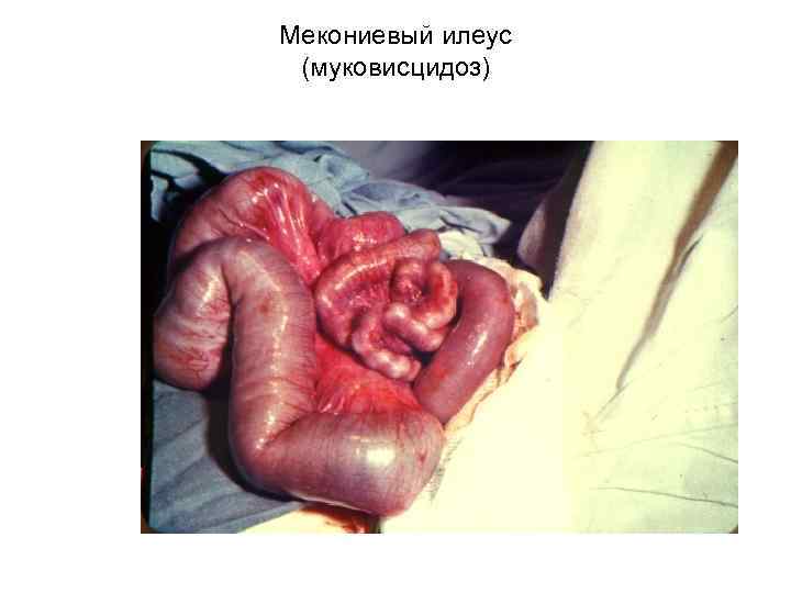 Мекониевый илеус (муковисцидоз) 