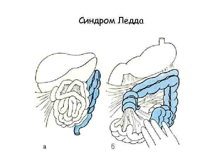 Синдром Ледда 