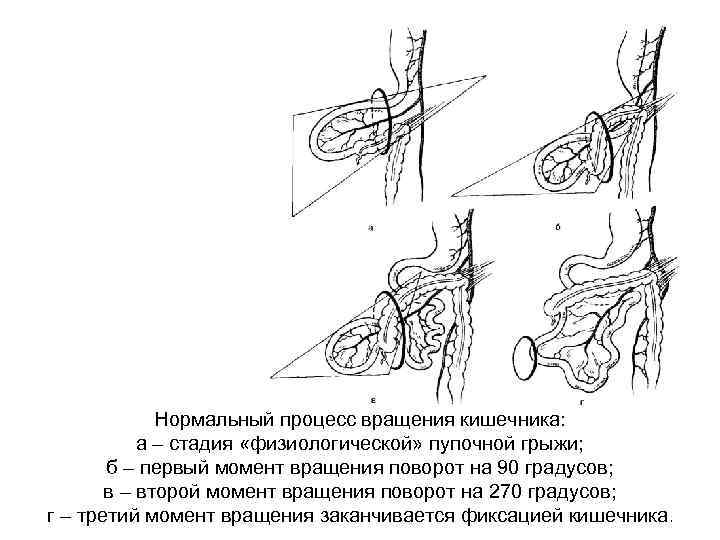 Нормальный процесс вращения кишечника: а – стадия «физиологической» пупочной грыжи; б – первый момент