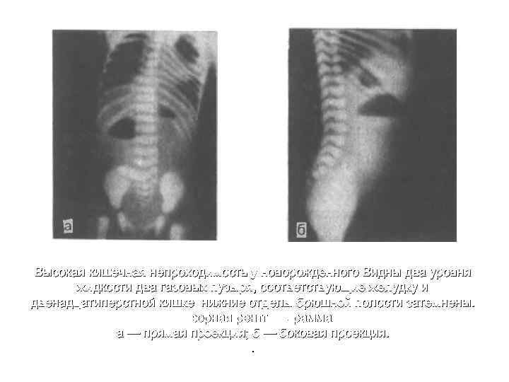Высокая кишечная непроходимость у новорожденного Видны два уровня жидкости два газовых пузыря, соответствующие желудку
