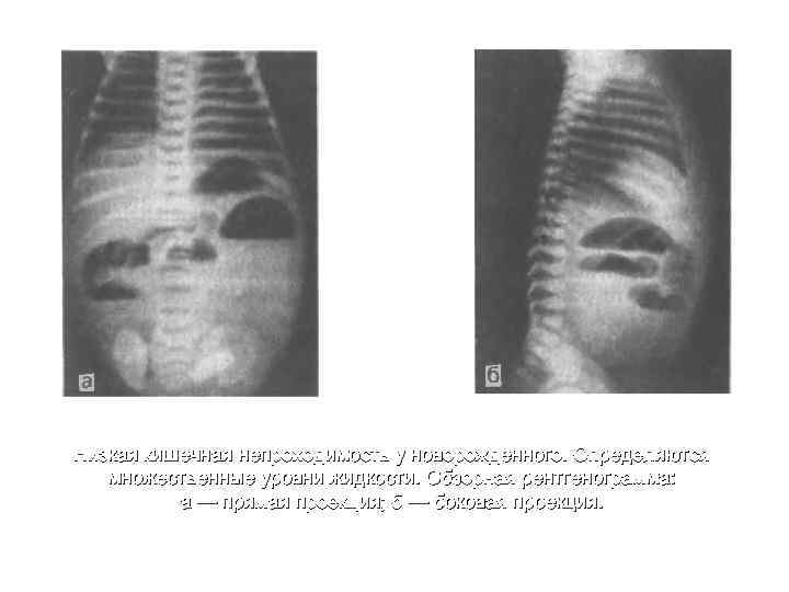 Низкая кишечная непроходимость у новорожденного. Определяются множественные уровни жидкости. Обзорная рентгенограмма: а — прямая