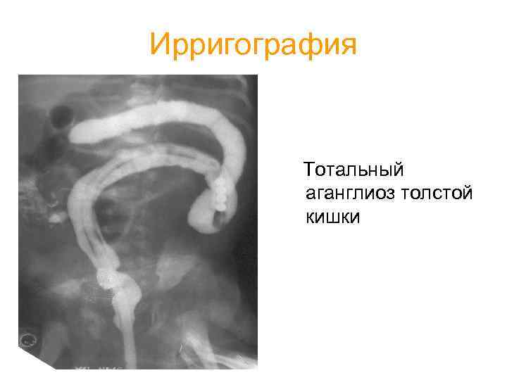Ирригография Тотальный аганглиоз толстой кишки 