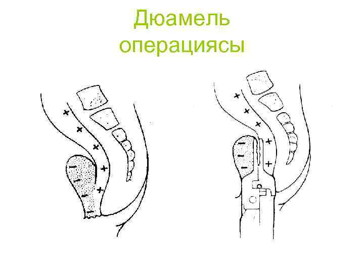 Дюамель операциясы 