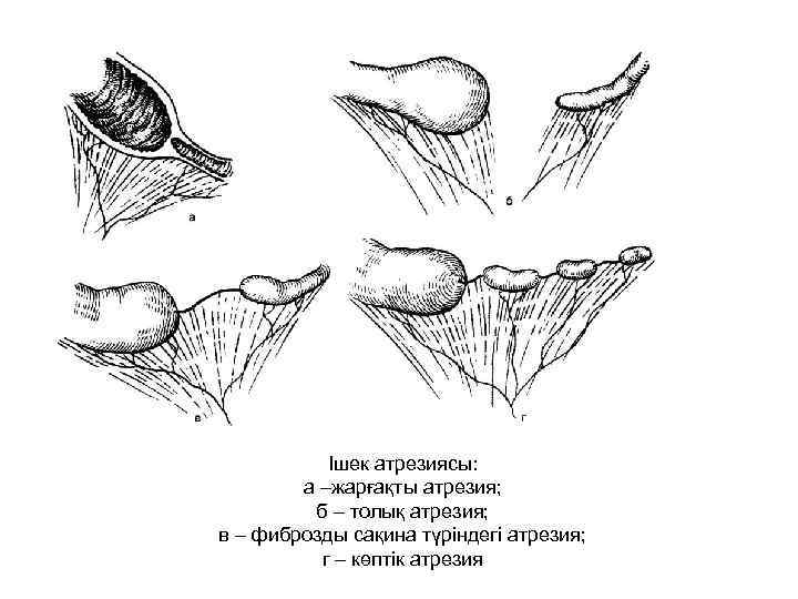Ішек атрезиясы: а –жарғақты атрезия; б – толық атрезия; в – фиброзды сақина түріндегі