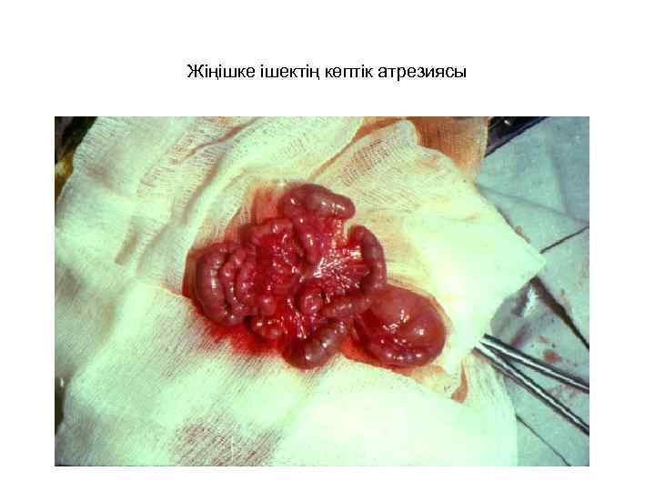 Жіңішке ішектің көптік атрезиясы 