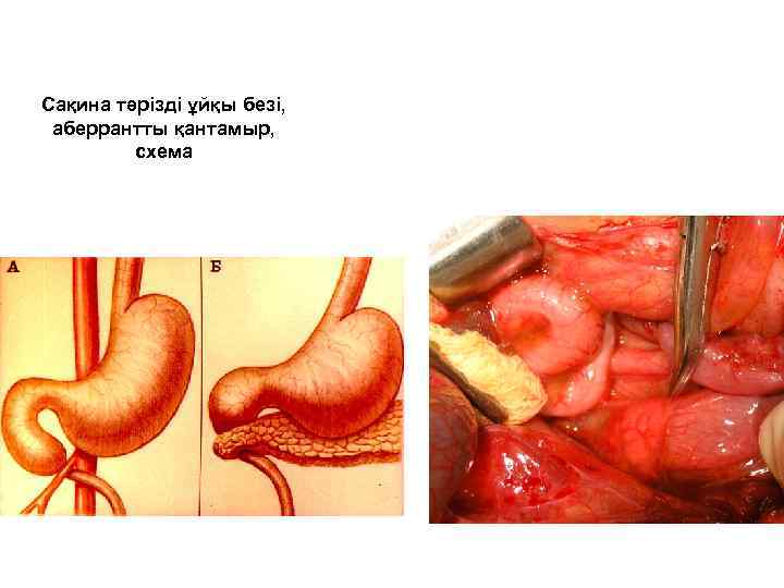 Сақина тәрізді ұйқы безі, аберрантты қантамыр, схема 