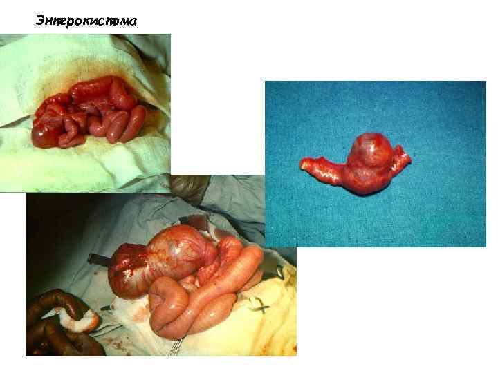 Энтерокистома 