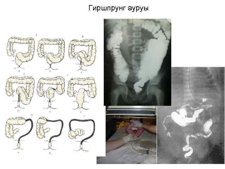 Гиршпрунг ауруы 