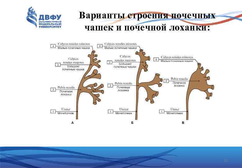 Варианты строения почечных чашек и почечной лоханки: 11 